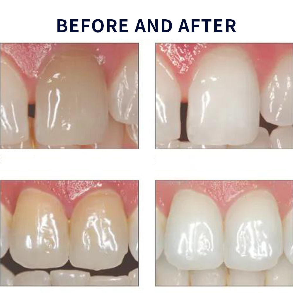 Opalescence Whitening 20% PF 2 - Teeth Whitening Hydrogen Peroxide 评论和价格
