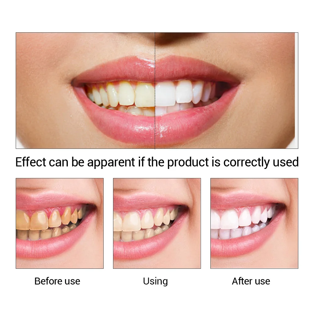 FTEENPLY Teeth Whitening Essen - Teeth Whitening Co 评论和价格
