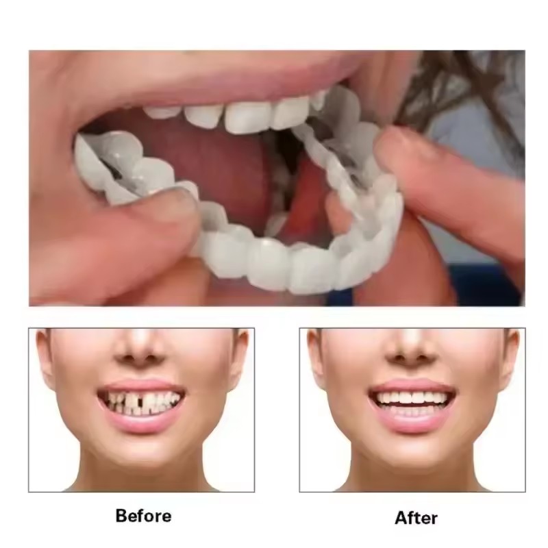 Teeth Veneers Whitening Dentur - Teeth Whitening Veneers 评论和价格