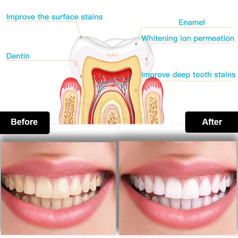 Dental Teeth Whitening Kit Min - Teeth Whitening Pen 评论和价格